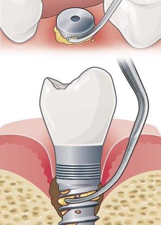 Debridement of the implant abutment and wide threads.